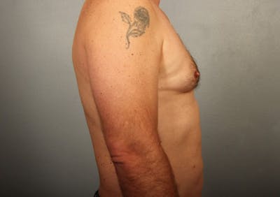 Male Body Contouring Before & After Gallery - Patient 176687 - Image 2
