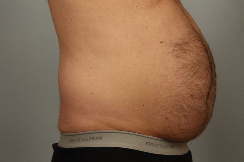 Liposuction Before & After Gallery - Patient 302695 - Image 1