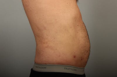 Male Body Contouring Before & After Gallery - Patient 203176 - Image 2