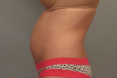 Liposuction Before & After Gallery - Patient 391781 - Image 1