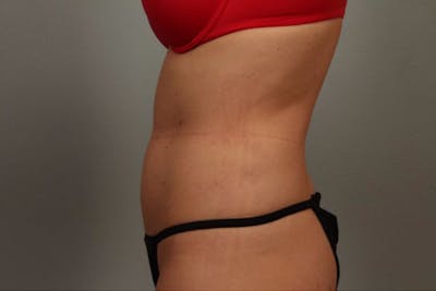 Liposuction Before & After Gallery - Patient 391781 - Image 2