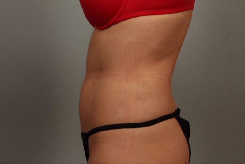 Liposuction Before & After Gallery - Patient 391781 - Image 2