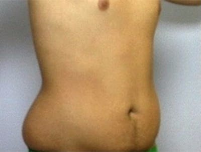 Male Body Contouring Before & After Gallery - Patient 289716 - Image 1