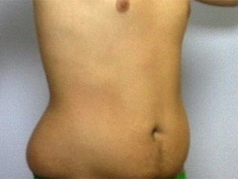Liposuction Before & After Gallery - Patient 184817 - Image 1