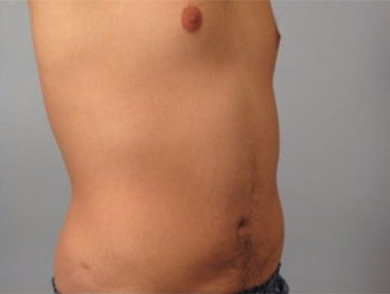 Liposuction Before & After Gallery - Patient 184817 - Image 2