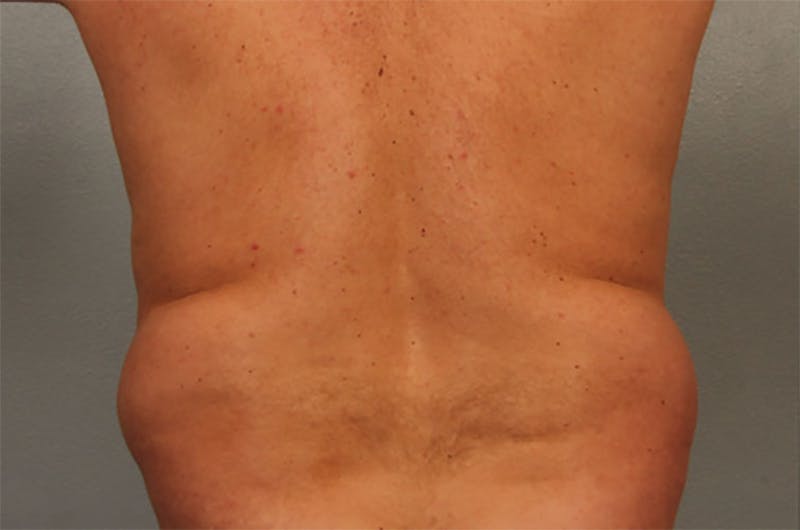 Male Body Contouring Before & After Gallery - Patient 190383 - Image 1