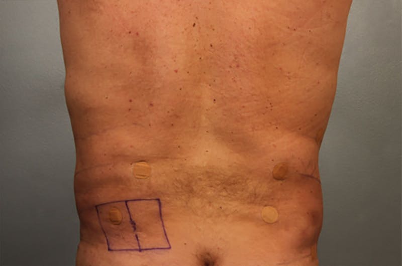Male Body Contouring Before & After Gallery - Patient 190383 - Image 2