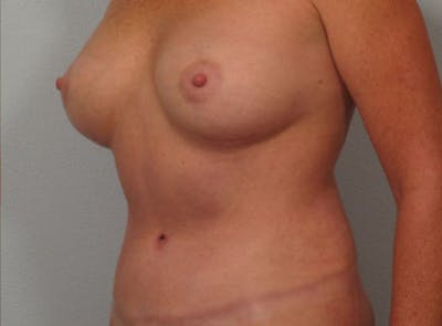 Mommy Makeover Before & After Gallery - Patient 326691 - Image 2