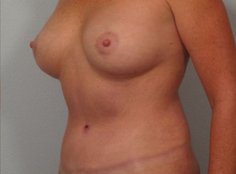 Mommy Makeover Before & After Gallery - Patient 326691 - Image 2
