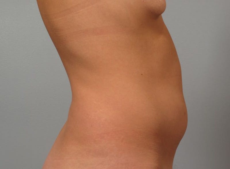 Mommy Makeover Before & After Gallery - Patient 305244 - Image 1