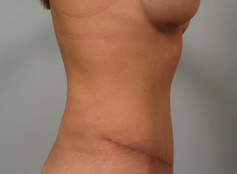 Mommy Makeover Before & After Gallery - Patient 305244 - Image 2