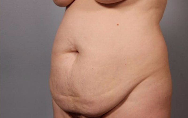 Mommy Makeover Before & After Gallery - Patient 236672 - Image 1