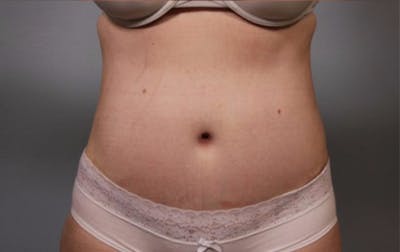 Tummy Tuck (Abdominoplasty) Before & After Gallery - Patient 143908 - Image 2