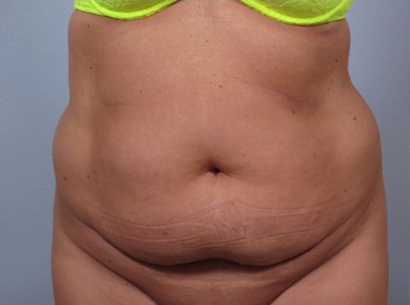 Mommy Makeover Before & After Gallery - Patient 170266 - Image 1