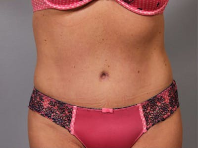 Tummy Tuck (Abdominoplasty) Before & After Gallery - Patient 291215 - Image 2