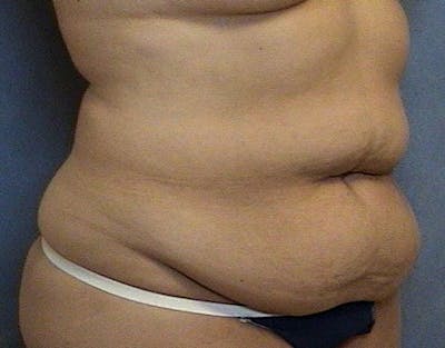 Tummy Tuck (Abdominoplasty) Before & After Gallery - Patient 166409 - Image 1