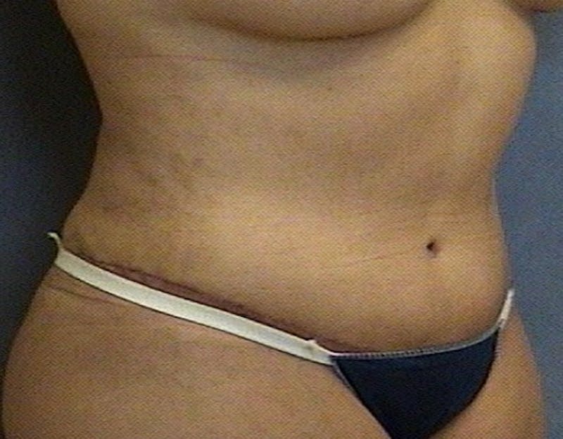 Mommy Makeover Before & After Gallery - Patient 256799 - Image 2