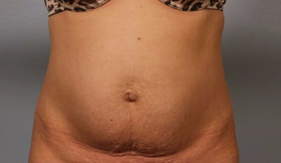 Tummy Tuck (Abdominoplasty) Before & After Gallery - Patient 984436 - Image 1