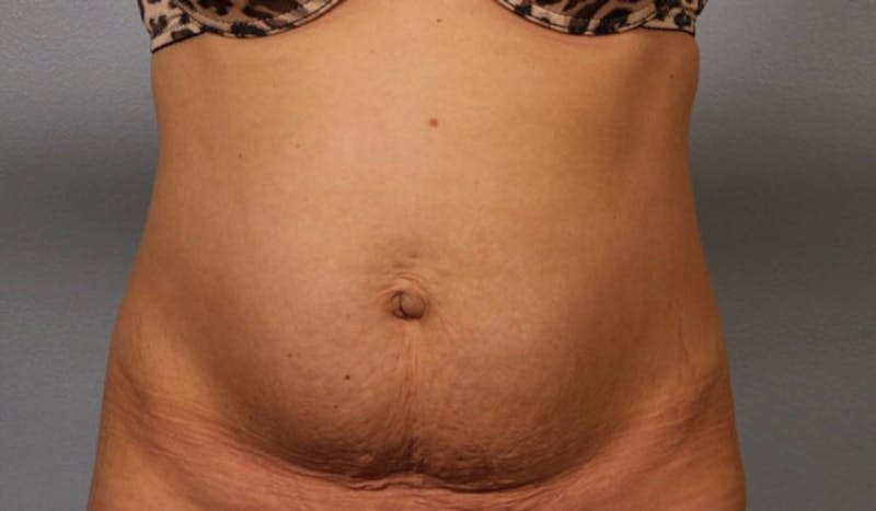 Tummy Tuck (Abdominoplasty) Before & After Gallery - Patient 984436 - Image 1