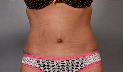 Tummy Tuck (Abdominoplasty) Before & After Gallery - Patient 984436 - Image 2