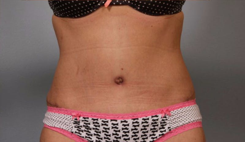 Tummy Tuck (Abdominoplasty) Before & After Gallery - Patient 984436 - Image 2