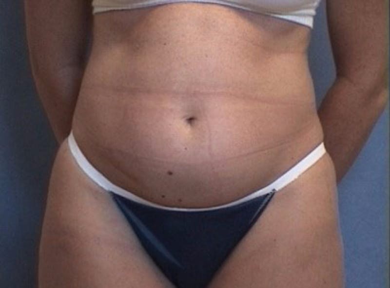 Mommy Makeover Before & After Gallery - Patient 405550 - Image 1