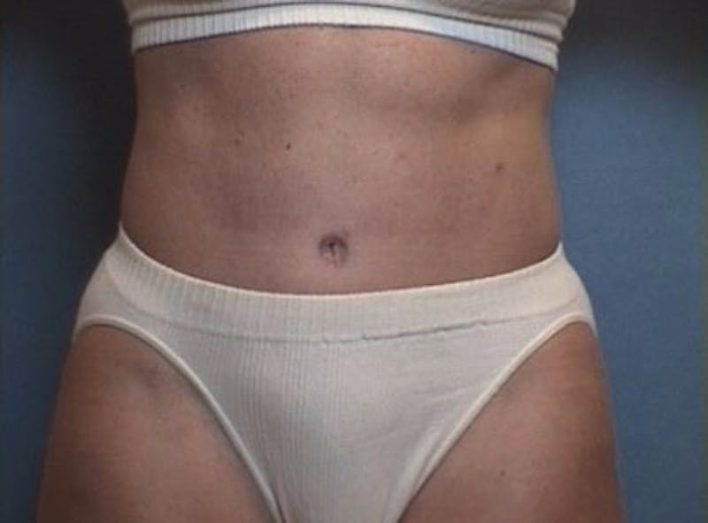 Mommy Makeover Before & After Gallery - Patient 405550 - Image 2