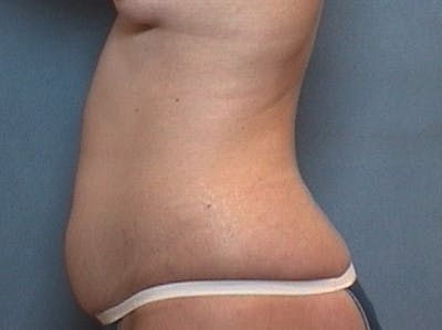 Tummy Tuck (Abdominoplasty) Before & After Gallery - Patient 109988 - Image 1
