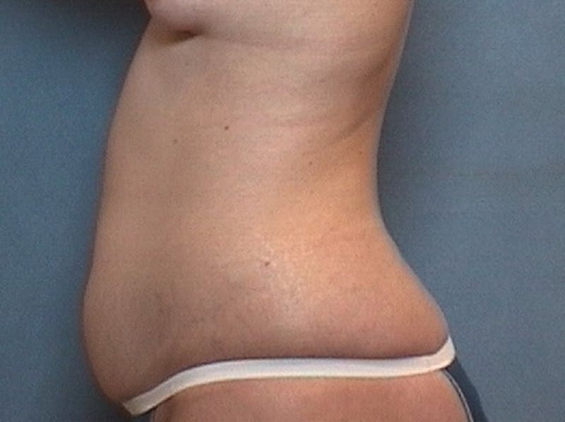 Tummy Tuck (Abdominoplasty) Before & After Gallery - Patient 109988 - Image 1