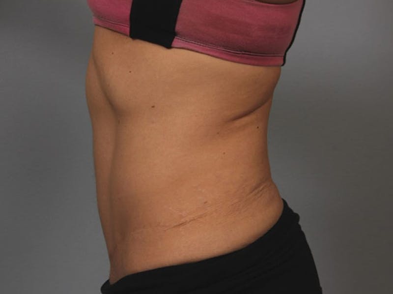 Tummy Tuck (Abdominoplasty) Before & After Gallery - Patient 109988 - Image 2