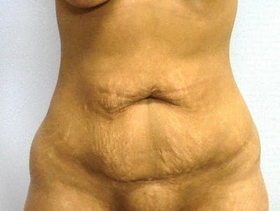 Mommy Makeover Before & After Gallery - Patient 135106 - Image 1