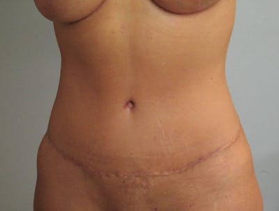 Mommy Makeover Before & After Gallery - Patient 135106 - Image 2