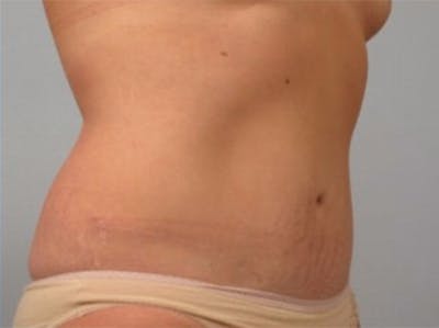 Mommy Makeover Before & After Gallery - Patient 407160 - Image 2