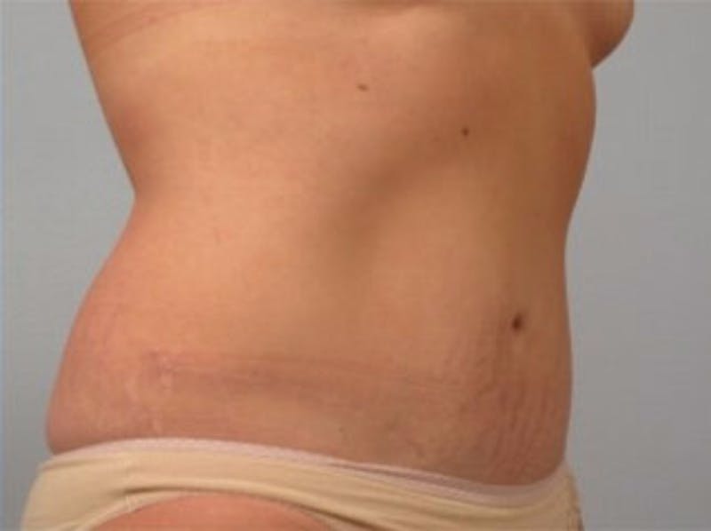 Mommy Makeover Before & After Gallery - Patient 407160 - Image 2