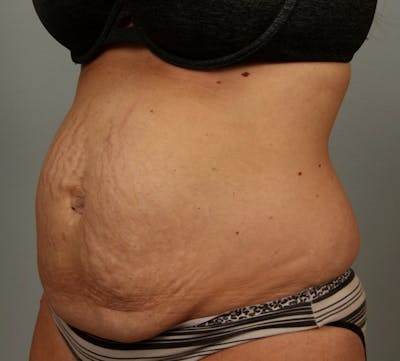 Tummy Tuck (Abdominoplasty) Before & After Gallery - Patient 133163 - Image 1