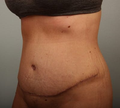 Tummy Tuck (Abdominoplasty) Before & After Gallery - Patient 133163 - Image 2
