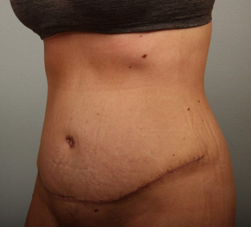 Tummy Tuck (Abdominoplasty) Before & After Gallery - Patient 133163 - Image 2