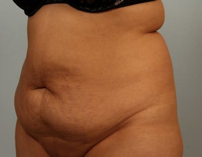 Tummy Tuck (Abdominoplasty) Before & After Gallery - Patient 107377 - Image 1