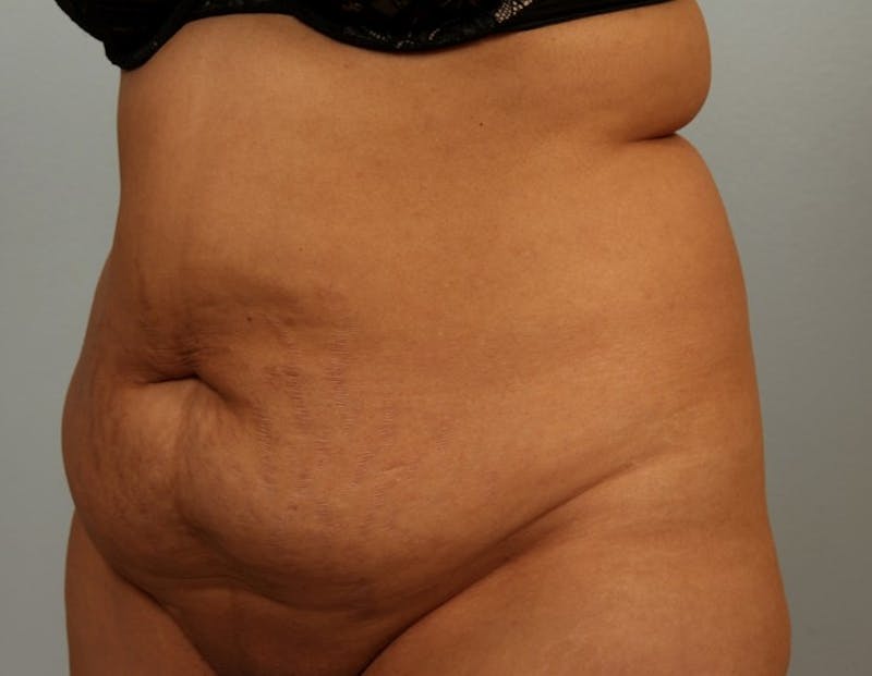 Tummy Tuck (Abdominoplasty) Before & After Gallery - Patient 107377 - Image 1