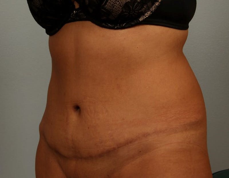 Tummy Tuck (Abdominoplasty) Before & After Gallery - Patient 107377 - Image 2