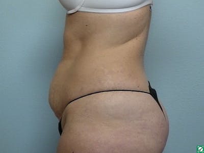 Tummy Tuck (Abdominoplasty) Before & After Gallery - Patient 147394 - Image 1