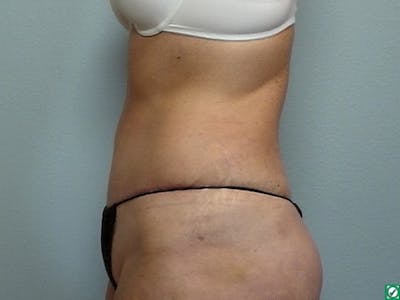 Tummy Tuck (Abdominoplasty) Before & After Gallery - Patient 147394 - Image 2