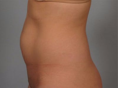 Tummy Tuck (Abdominoplasty) Before & After Gallery - Patient 223494 - Image 1