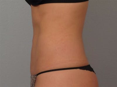Tummy Tuck (Abdominoplasty) Before & After Gallery - Patient 223494 - Image 2