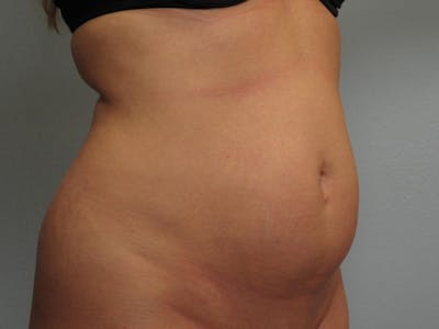 Tummy Tuck (Abdominoplasty) Before & After Gallery - Patient 528637 - Image 1