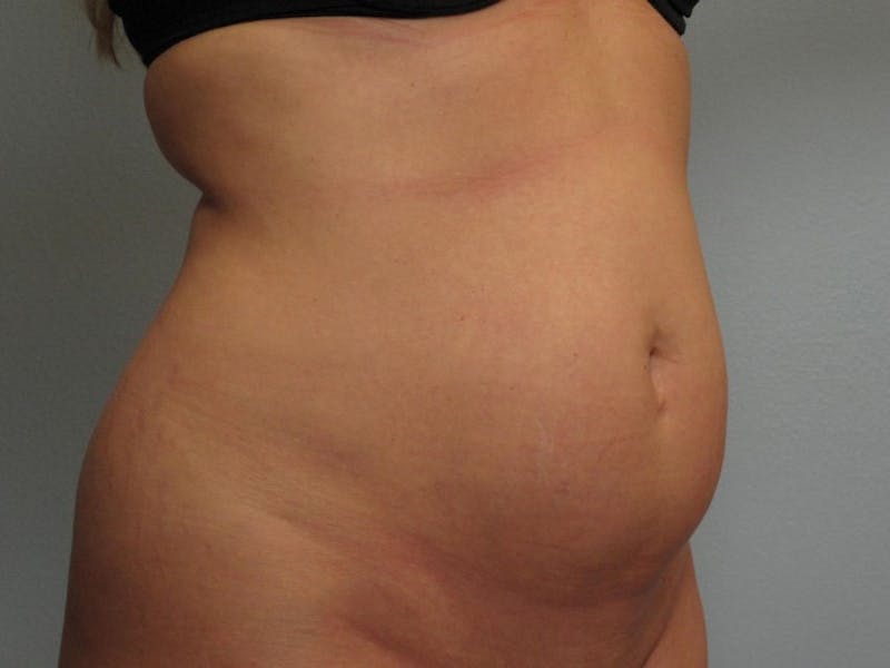 Tummy Tuck (Abdominoplasty) Before & After Gallery - Patient 528637 - Image 1