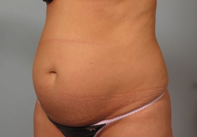 Tummy Tuck (Abdominoplasty) Before & After Gallery - Patient 193958 - Image 1