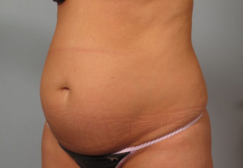 Tummy Tuck (Abdominoplasty) Before & After Gallery - Patient 193958 - Image 1