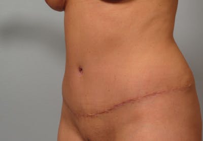 Tummy Tuck (Abdominoplasty) Before & After Gallery - Patient 193958 - Image 2