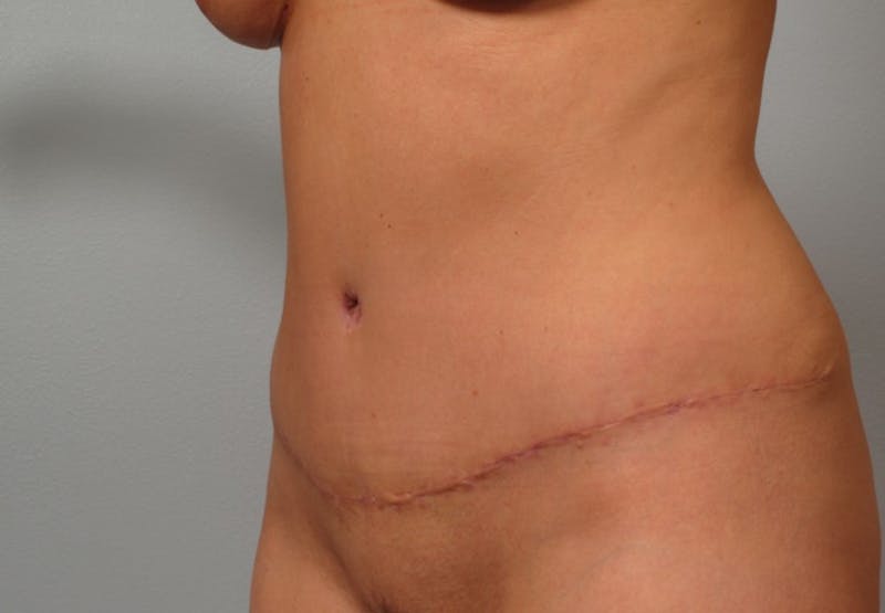 Tummy Tuck (Abdominoplasty) Before & After Gallery - Patient 193958 - Image 2